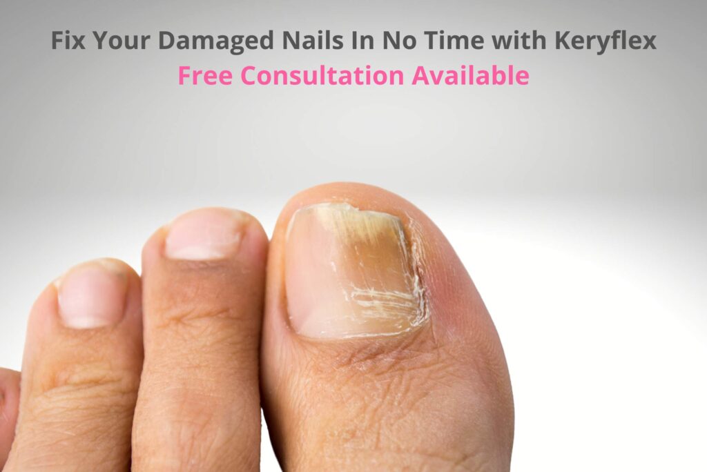 Keryflex Nail Restoration - FOOTPRINTS PODIATRY