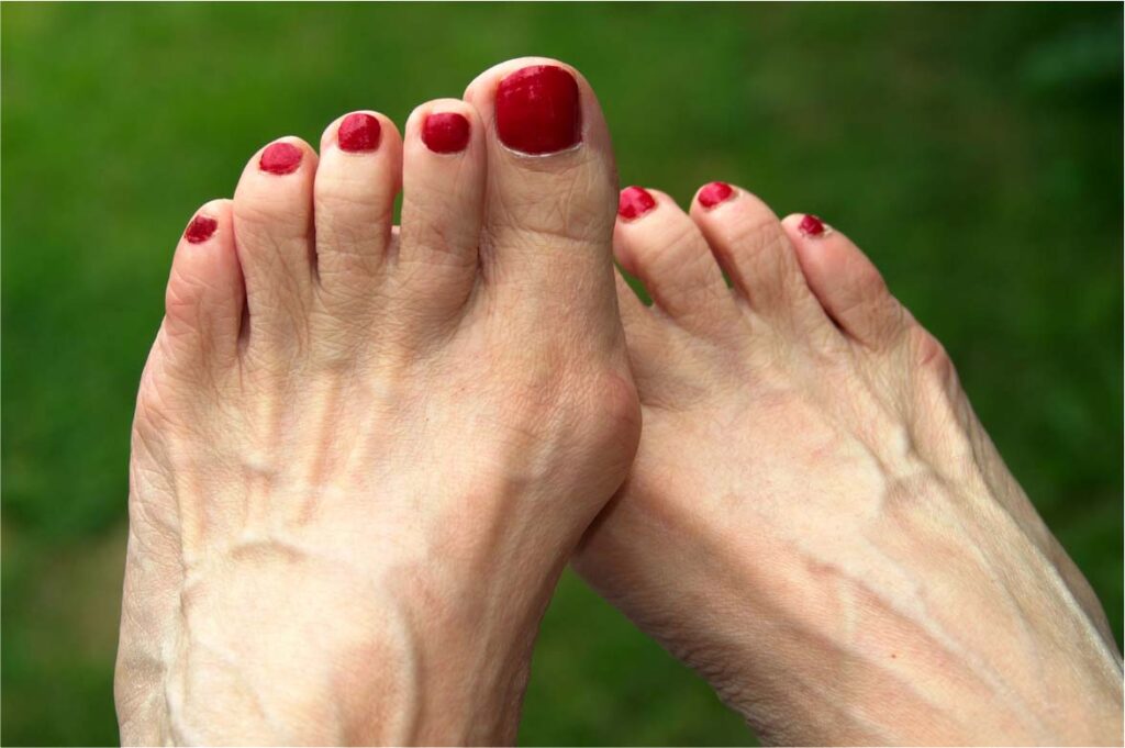 Bunions treatment in Melbourne CBD